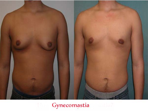 Difference between Gynecomastia and Pseudogynecomastia Sample