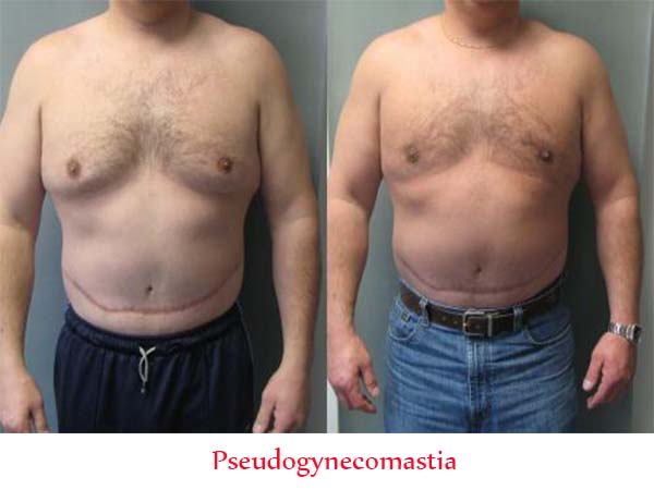 Difference between Pseudogynecomastia and Gynecomastia Sample
