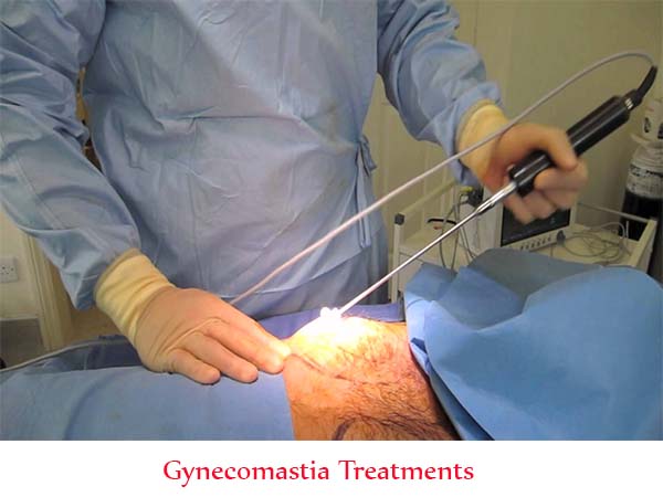 Gynecomastia Treatments Surgery