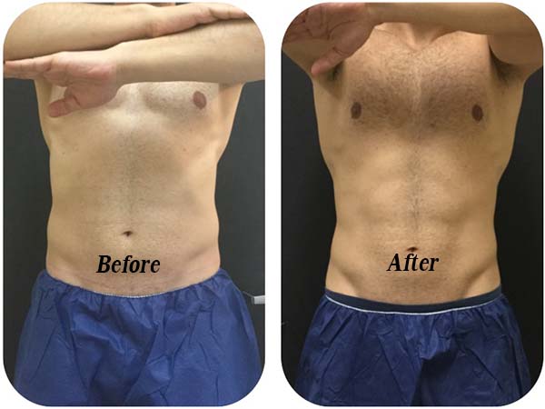 coolsculpting for men remove belly before and after