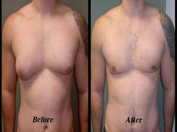 coolsculpting for men remove men breast before and after