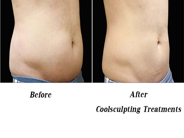 coolsculpting for men target abdomen before and after