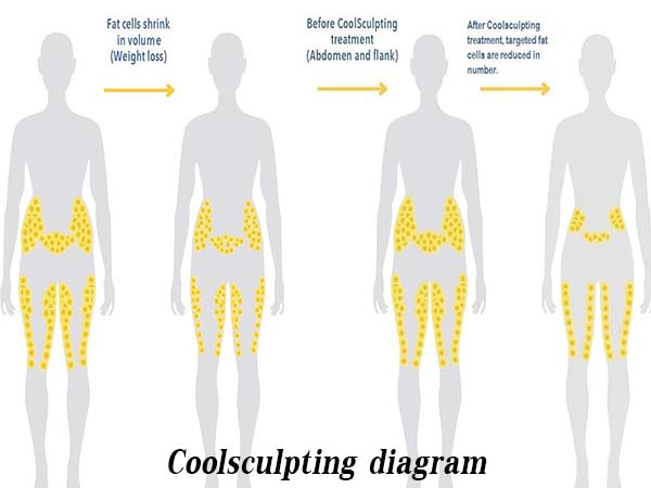 men coolsculpting process diagram
