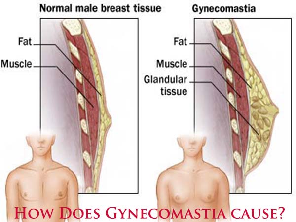 How Does Gynecomastia Happen