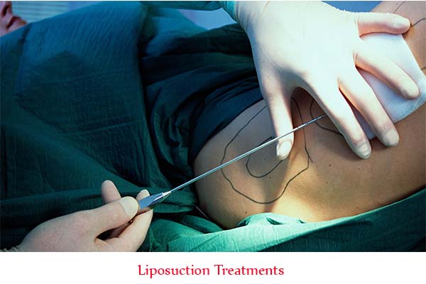 Liposuction treatments