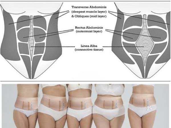 Abdominal binders after outlet c section