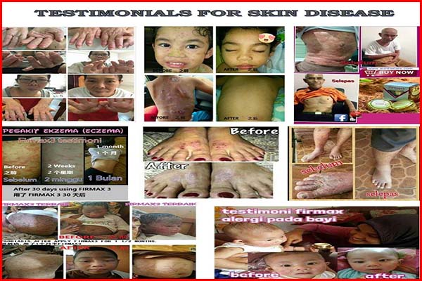firmax3 testimoni for skin disease sample