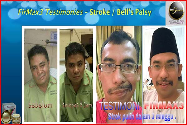 firmax3 testimonial for stroke bell palsy